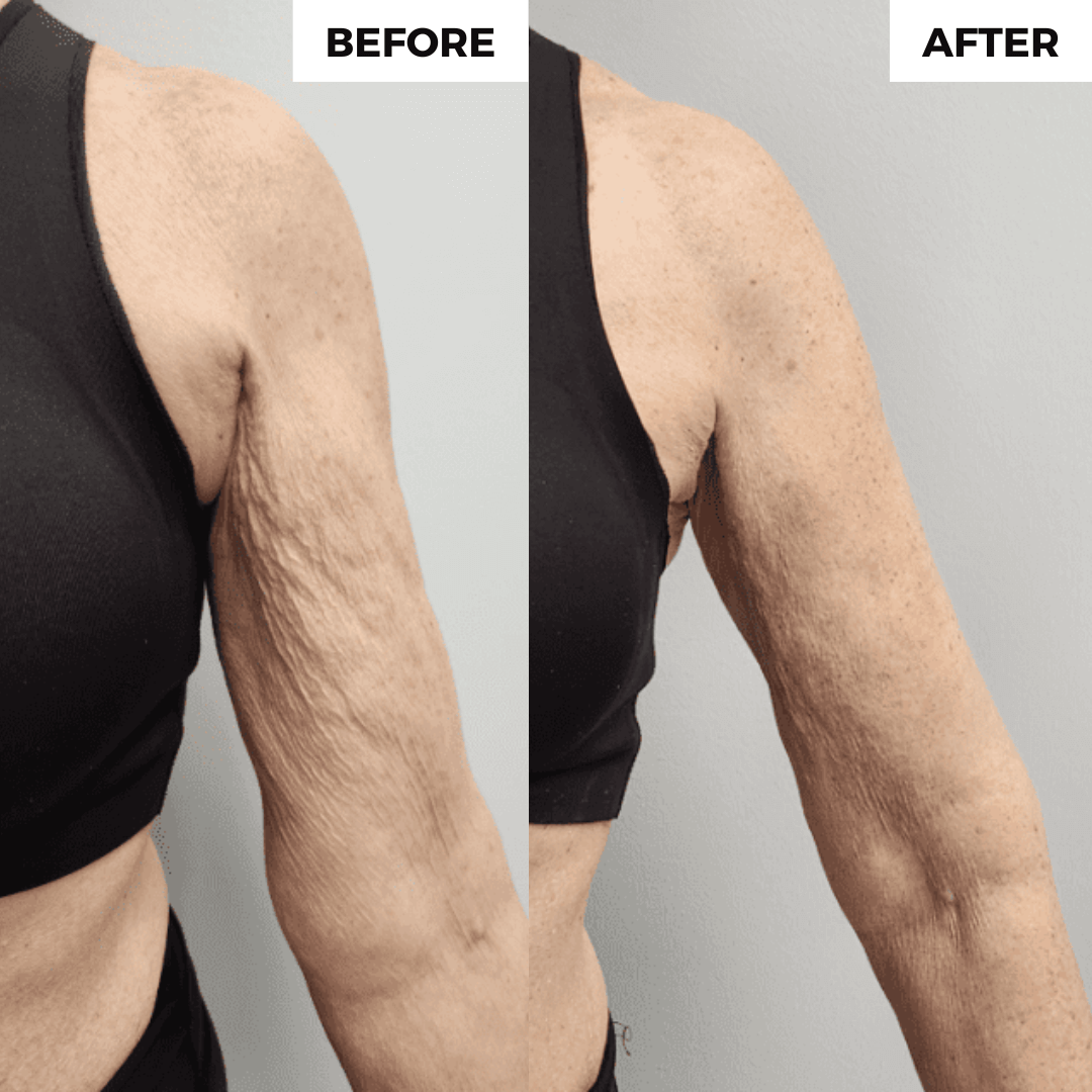Before and after results of using Confitone® ThermoTone Arm Sleeve (Pair of 2) for improved arm contour.